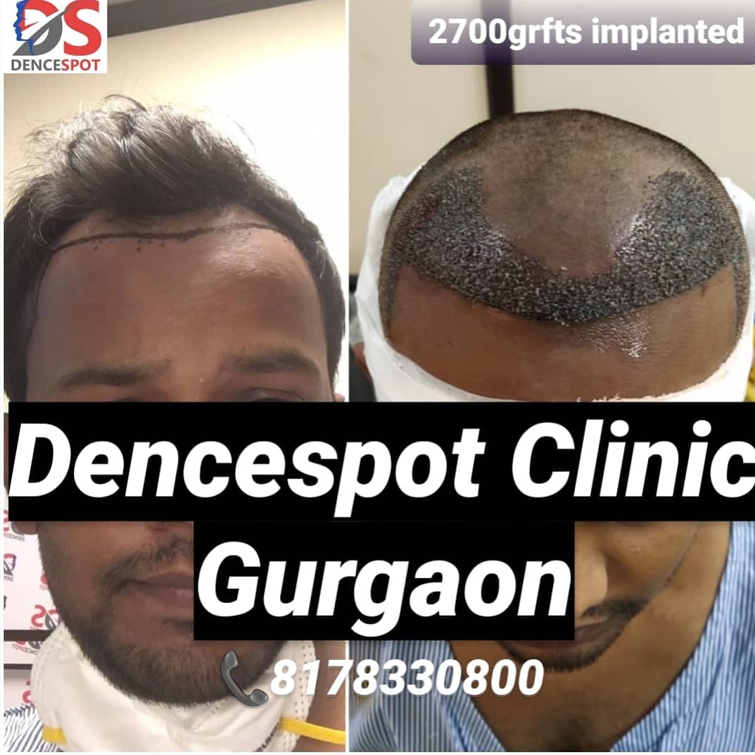 DenceSpot Patient Result Transformation